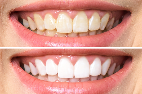 Is in-office teeth whitening worth the cost?