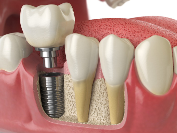 Reasons You Should Consider Dental Implants | Dental Remedies