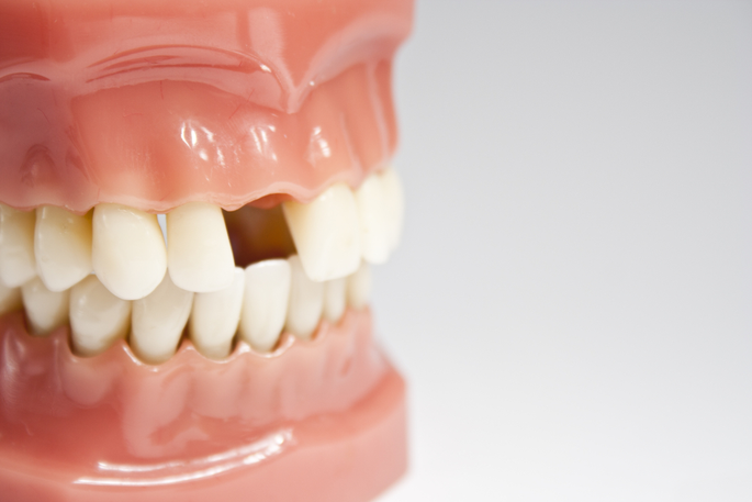 Tooth Replacement Options to Consider | Dental Remedies