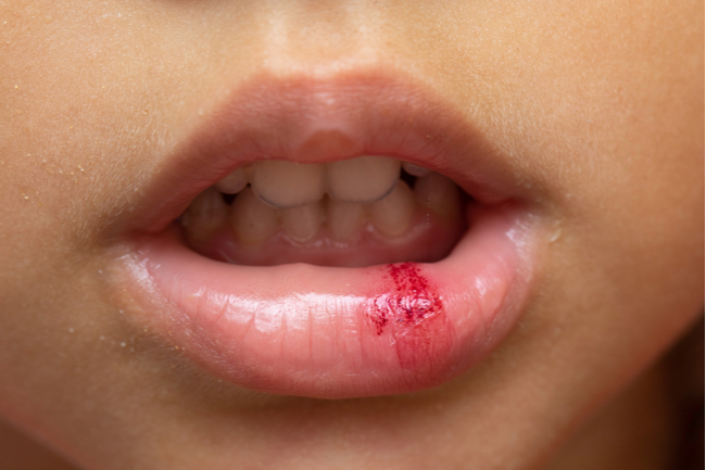 What to do When Your Kid Injures a Tooth | Dental Remedies