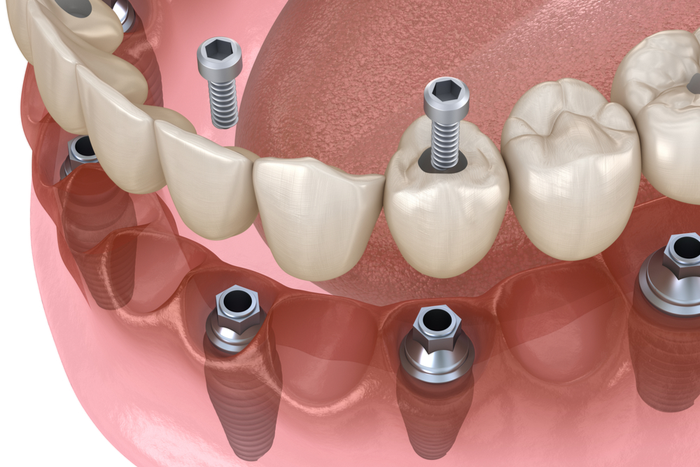 What You Need to Know Before Getting Dental Implants | Dental Remedies