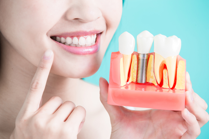 The Basics of Dental Implants