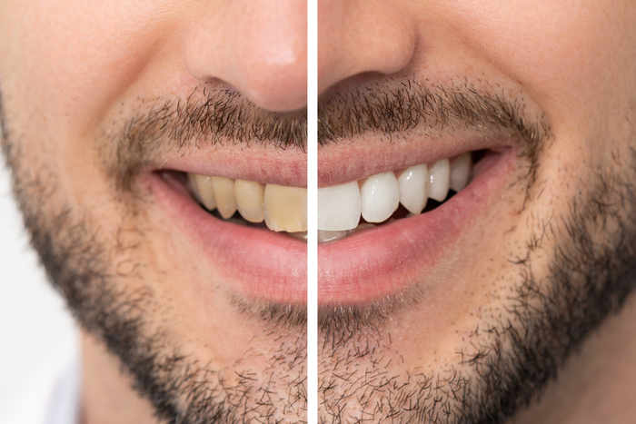 Top 3 Reasons You Have Yellow Teeth and What You Can Do About It