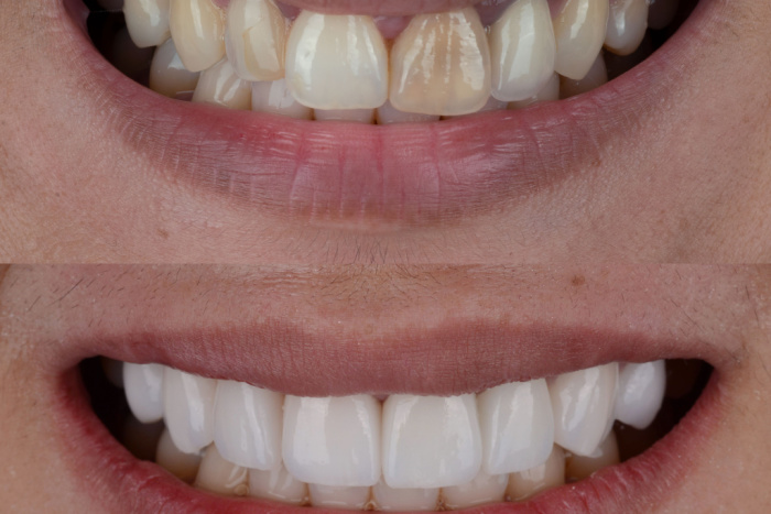 Are Porcelain Veneers a Good Option for Me?
