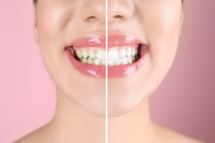 Are In-Office Teeth Whitening Treatments Effective?