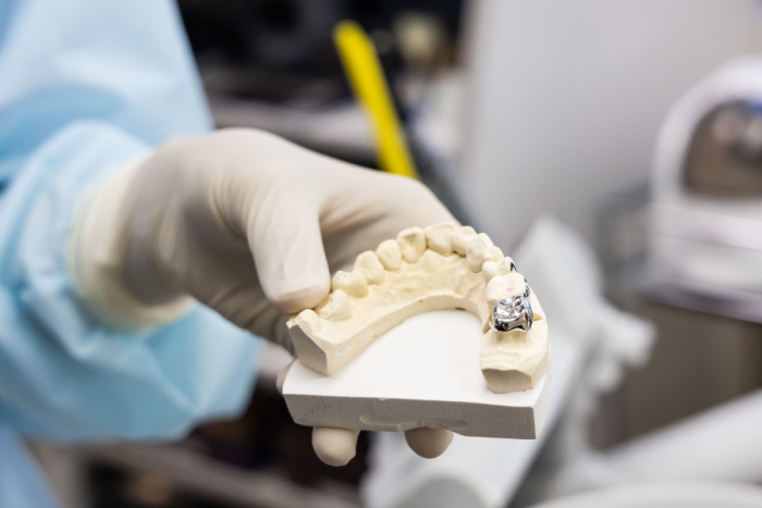 Are Dental Crowns a Good Option for Me?