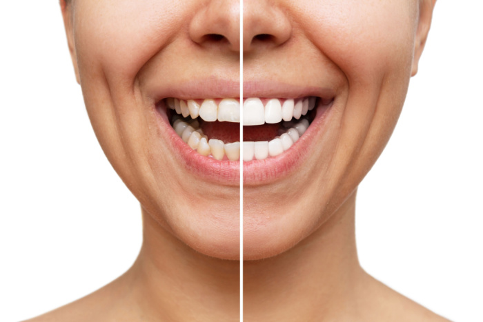 What are the Benefits of Porcelain Veneers?