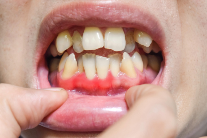 Exploring the Causes of Swollen Gums